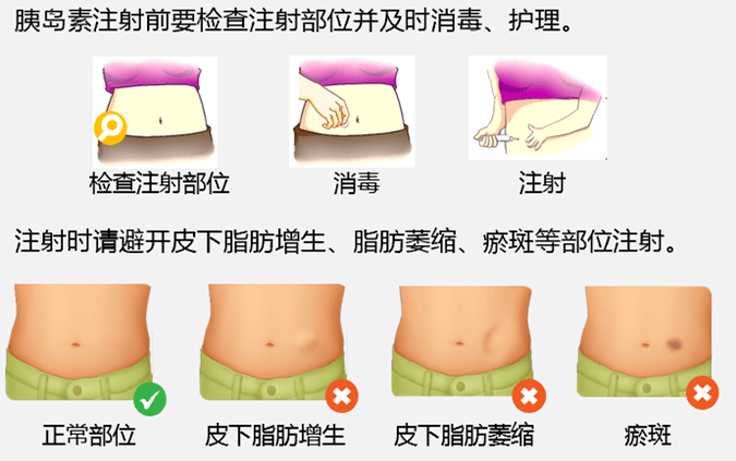 胰岛素注射腹部区域图图片