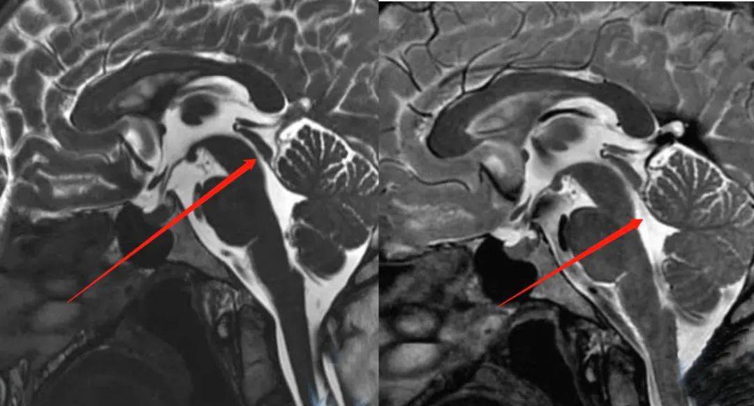 右图于中脑导水管下方出口处,可见细丝样流空低信号影,为i度,轻度狭窄