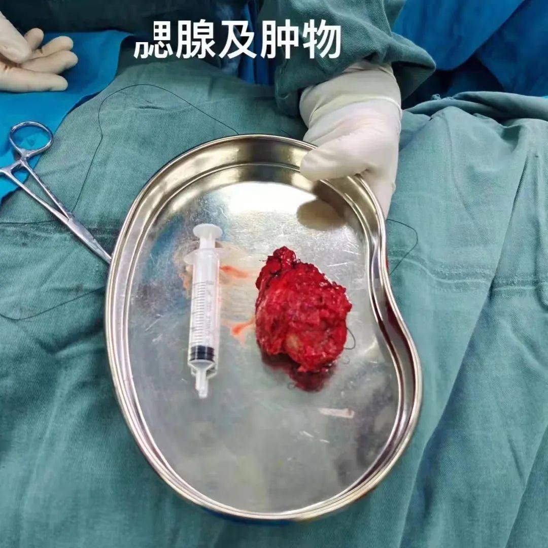 我院耳鼻喉科完成一例高龄患者腮腺肿物全切术