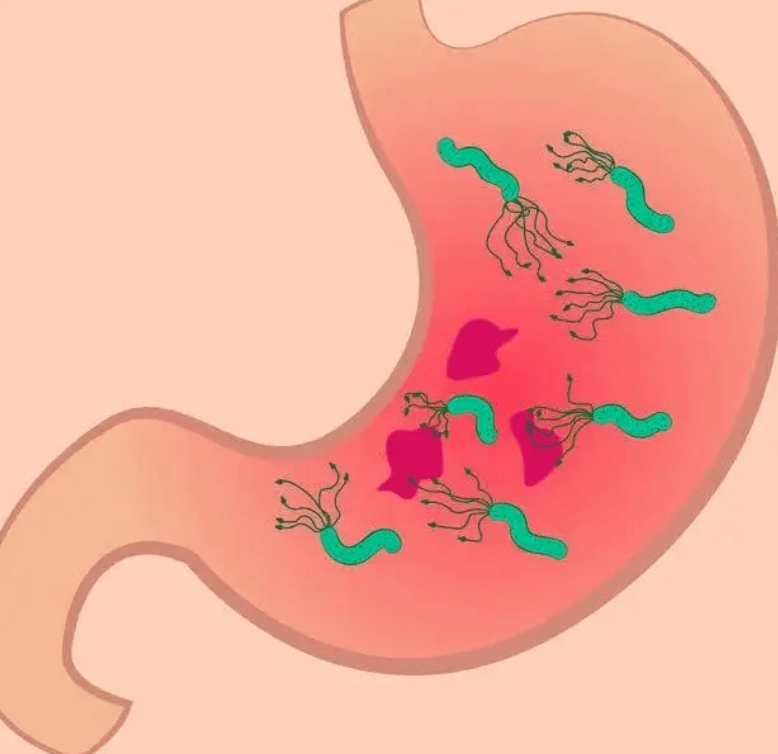 糜烂性胃炎报告单图片图片