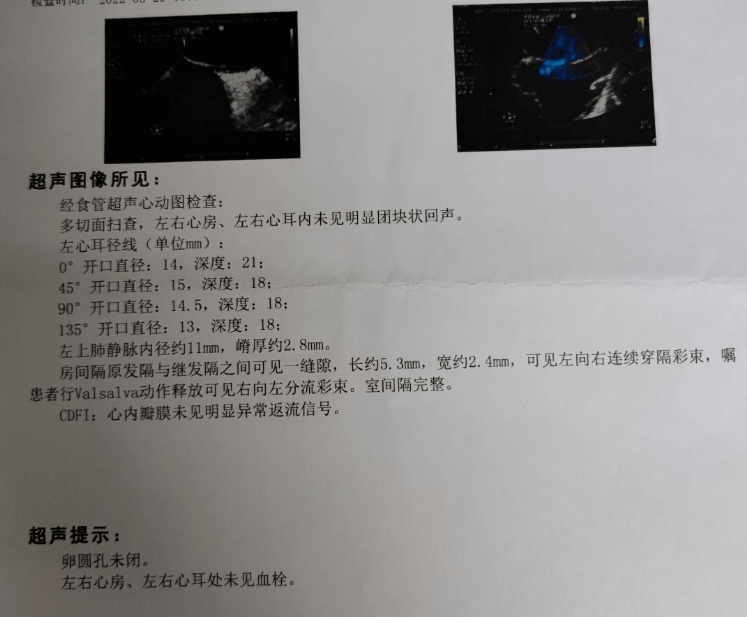 随后,广医三院心血管专家通过经食管超声心动图检查发现,小梁心脏"