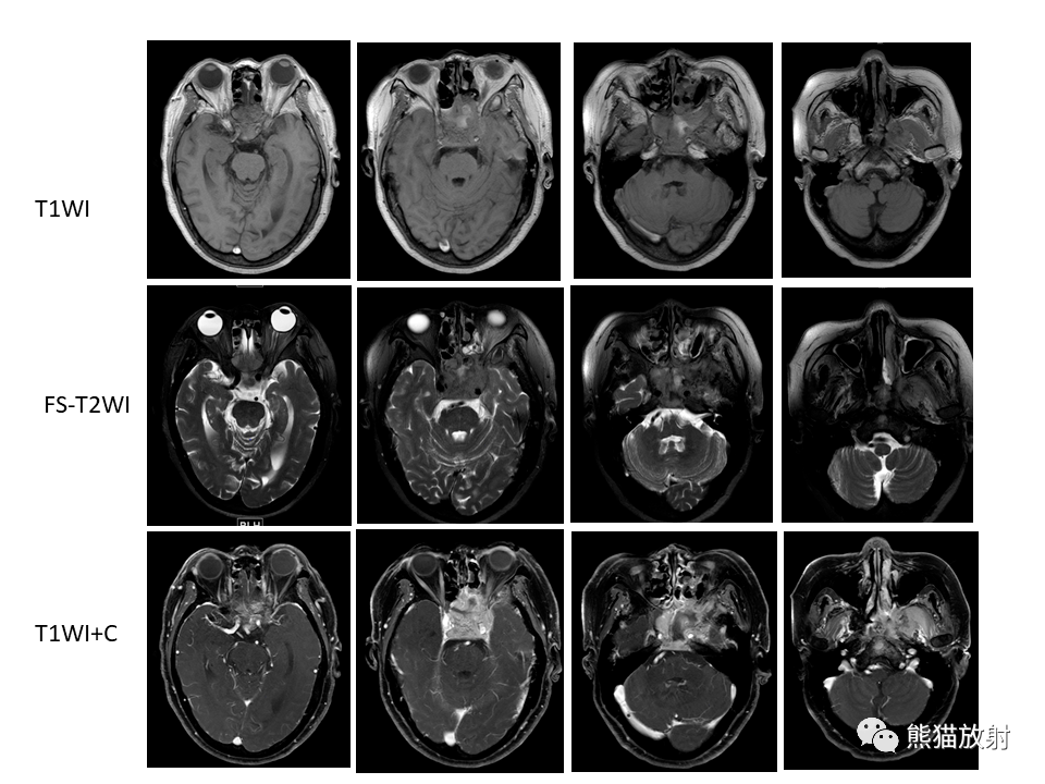 省立影像读片鼻腔鼻窦病变2204
