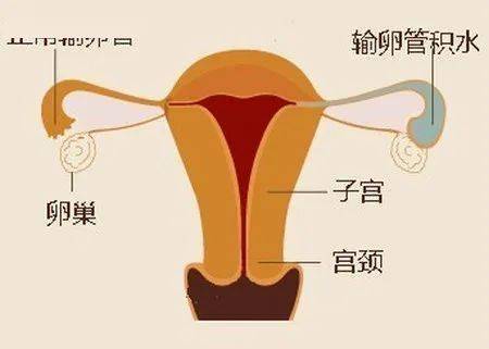 女性盆腔感染后,炎症若未及时彻底治愈,炎性渗出物会不断积聚超过机体