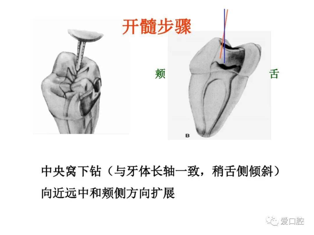 乳磨牙开髓部位图片