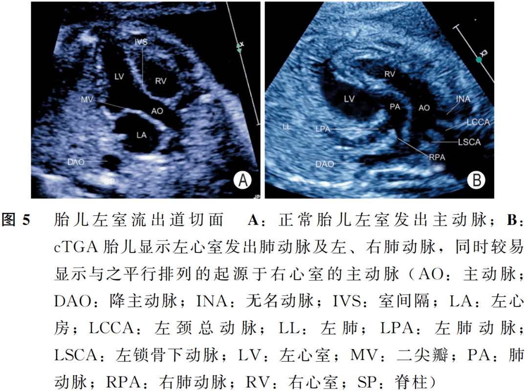 庆祝胎儿完全型大动脉转位中孕期超声检查中国专家共识2022版发布