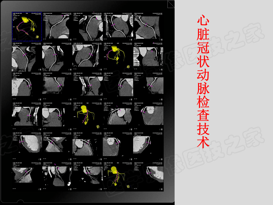 冠状动脉造影报告单图片