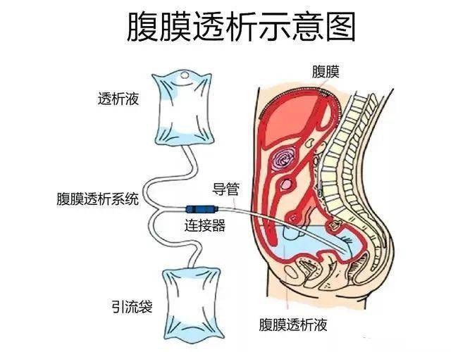 腹膜透析机管路图片