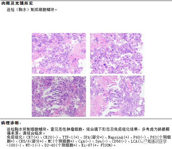 肺结节诊断报告图片图片