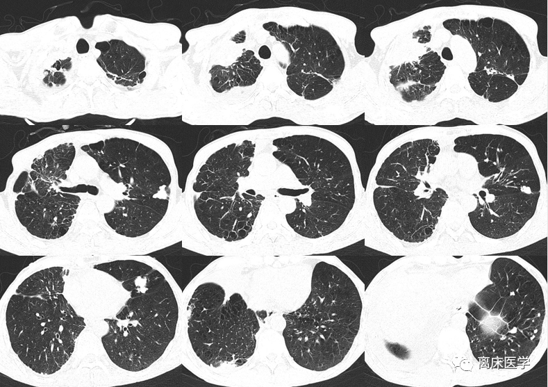 肺部阴影待查;2.胸腔积液.