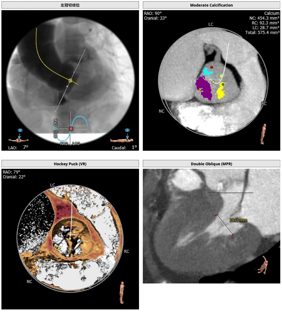 重庆医科大学附属第三医院心内科团队顺利完成高难度tavr手术一例