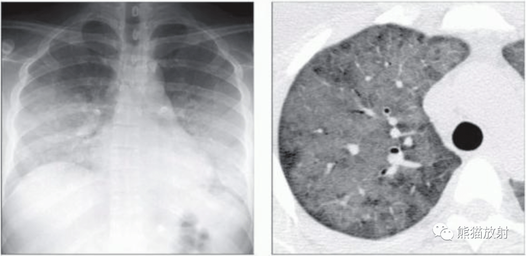 肺孢子菌肺炎卡肺肺寄生虫病丨影像表现