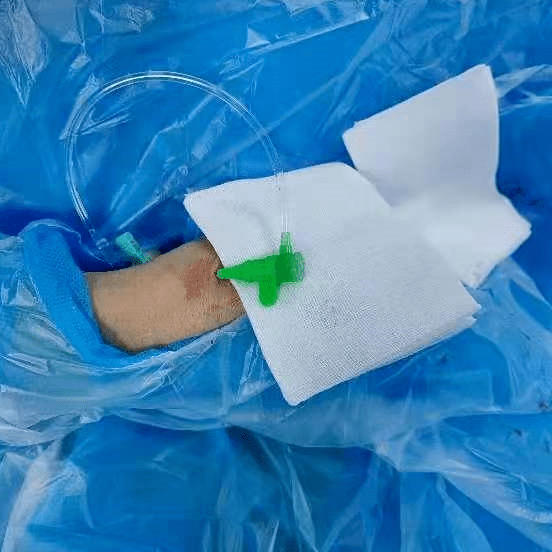 有励可说丨skathi远端通路导管在经桡动脉入路治疗右