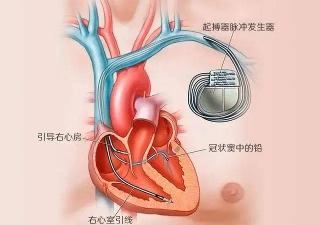 名医科普救命神器心脏起搏器