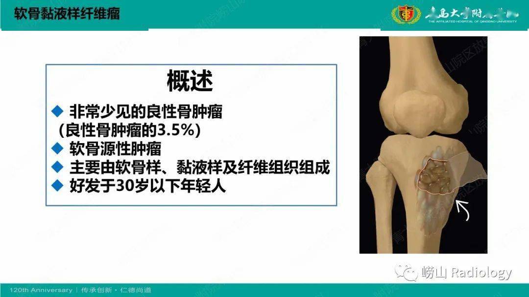 纤维命名相关骨肿瘤和肿瘤样病变的影像学鉴别诊断
