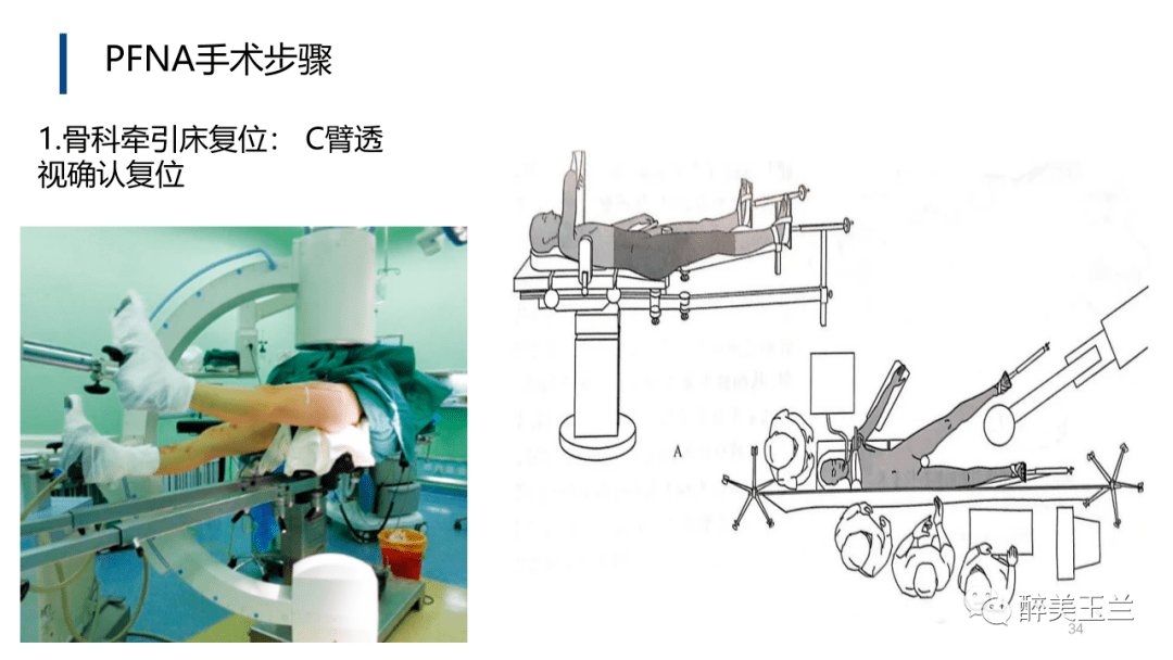 pfna内固定术图片