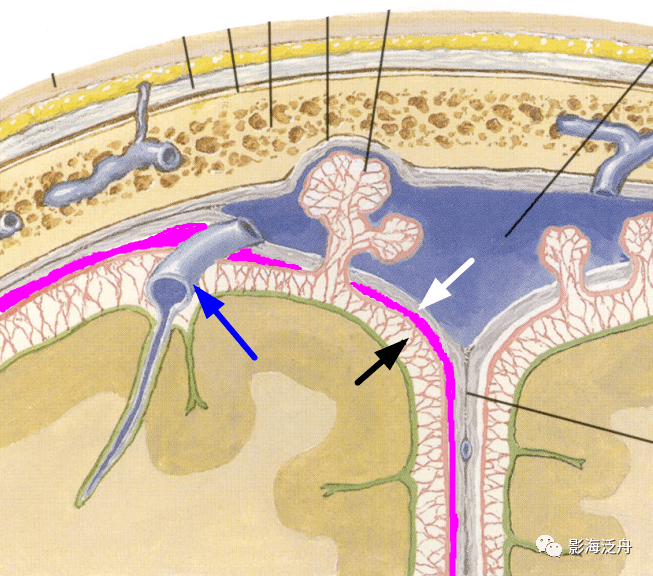 从图中不难看到硬膜下血肿大多是由邻近的桥静脉(蓝箭)破裂引起的