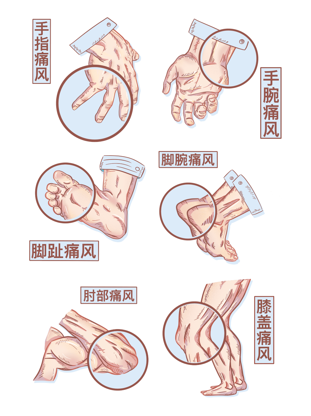 全民关注痛风日小心第四高逼近