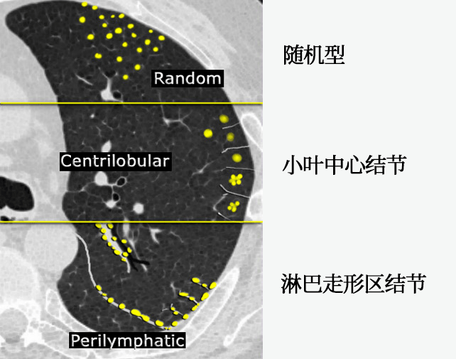 小叶中心结节示意图图片