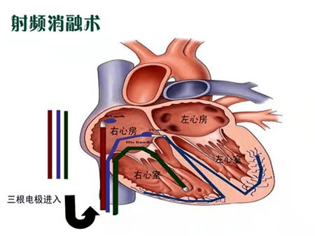 心脏射频消融术 让心脏重获"心"生