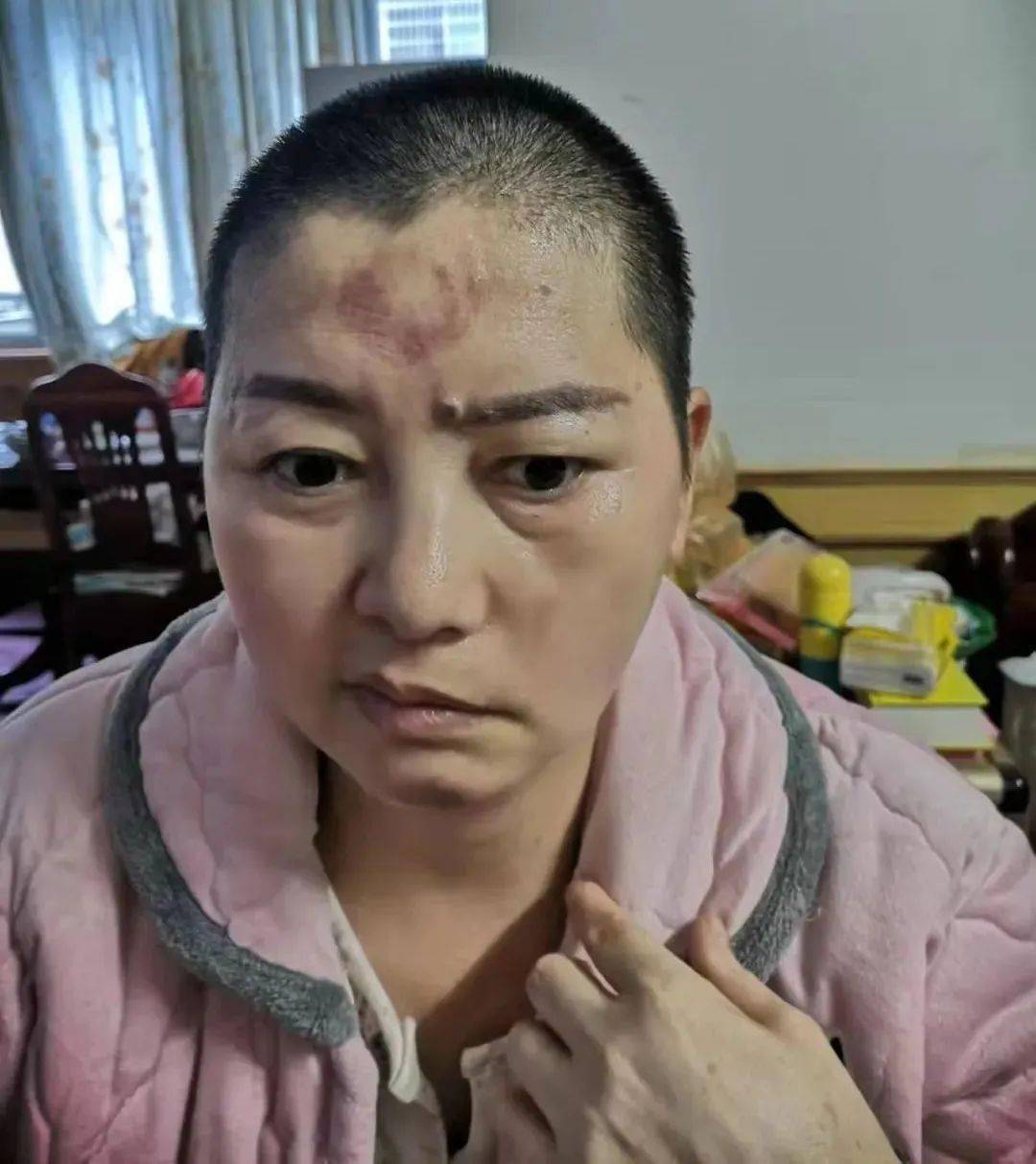 医案分享 | 温针灸治疗听神经瘤术后面瘫_感觉_理疗_症状