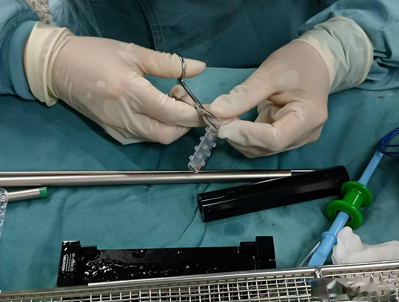 肺结核治疗不规范老人险失左肺省内首例cb硅酮支架成功保肺