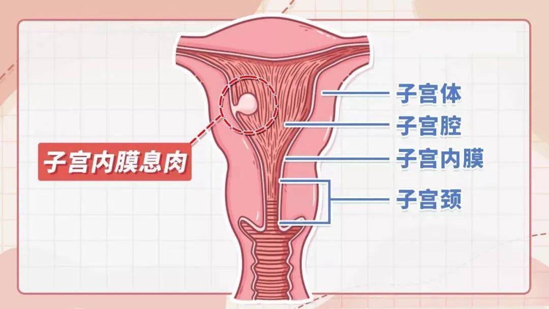 微医生得了子宫内膜息肉会影响我怀孕吗