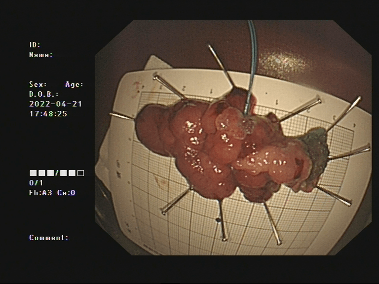 医文医话脾胃病科巨大带蒂息肉不开刀也能治内镜粘膜下剥离术esd