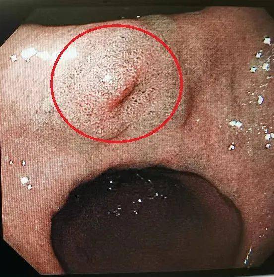 于是,医生取出一小块胃角粘膜病变组织进行活检.