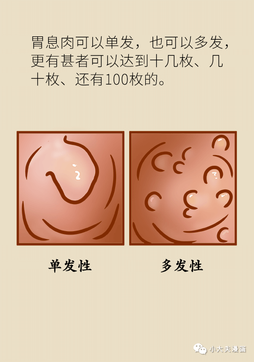 胃息肉癌变风险有多大看这2个指标