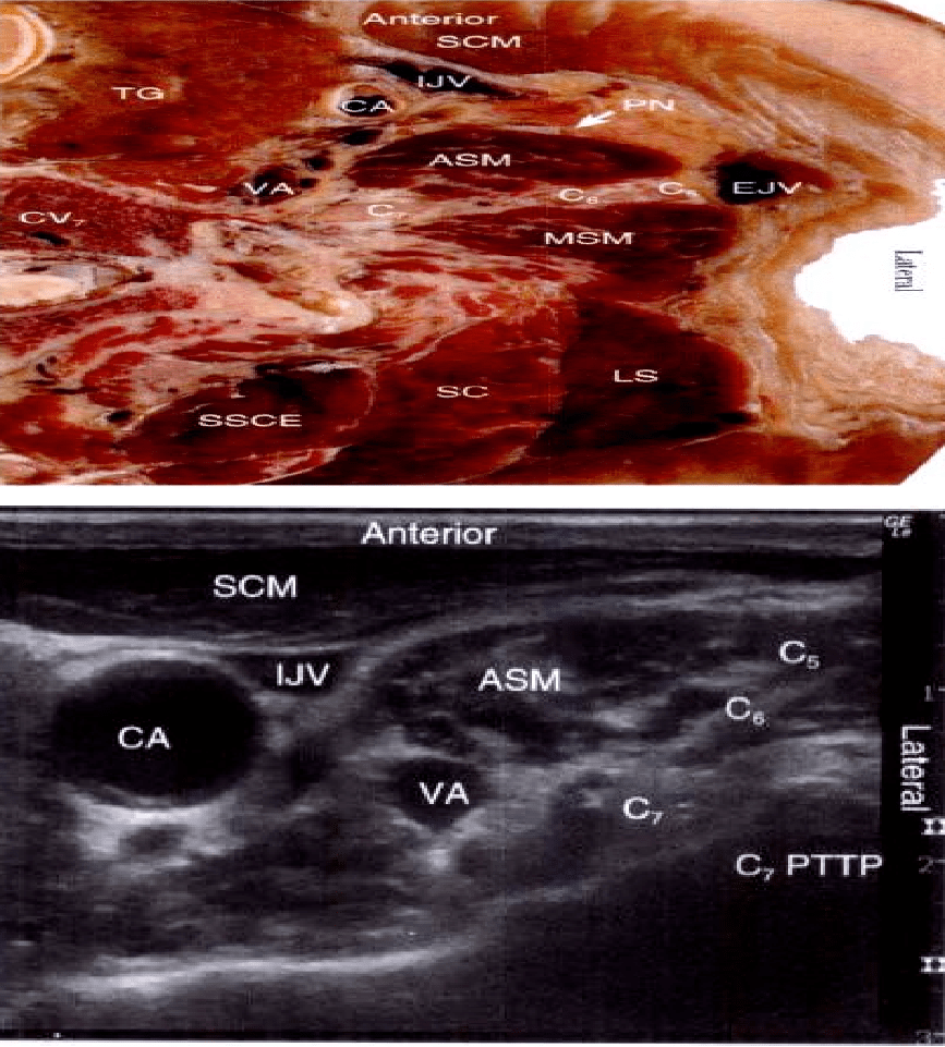 臂丛神经腋路超声图像图片