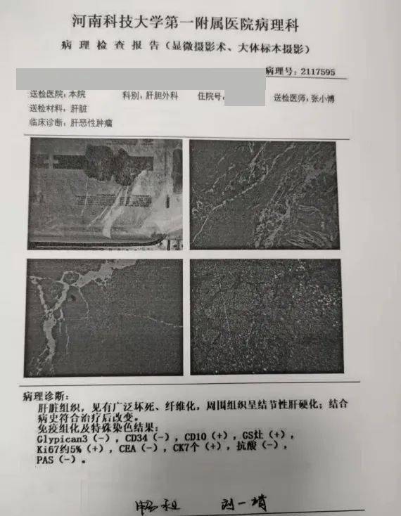 肝纤维化报告单图片图片