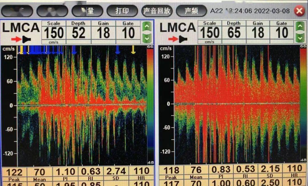 肖灿熟练地将发泡剂注入患者手臂肘静脉,经颅多普勒仪屏幕上本来"安静