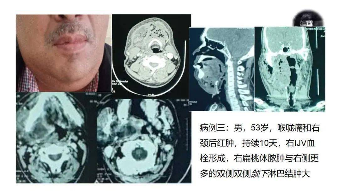 扁桃体纤维瘤形状图片图片