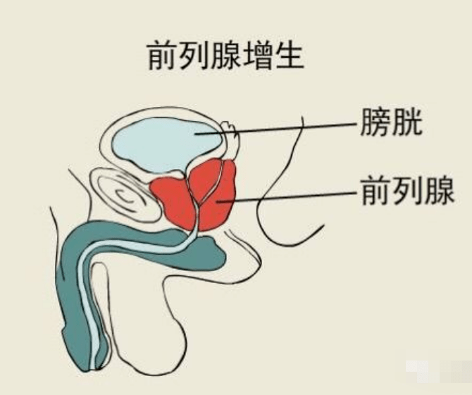 這是病,得治!_前列腺_廁所_膀胱