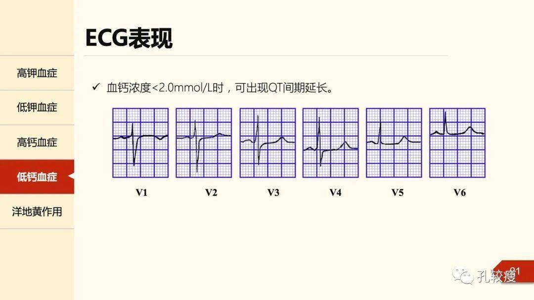 基础知识丨电解质紊乱的ecg表现_心电图_血清_诊断