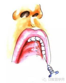 刺入黏膜下,再移注射器至患侧,向后上方进针少许即达腭大孔处