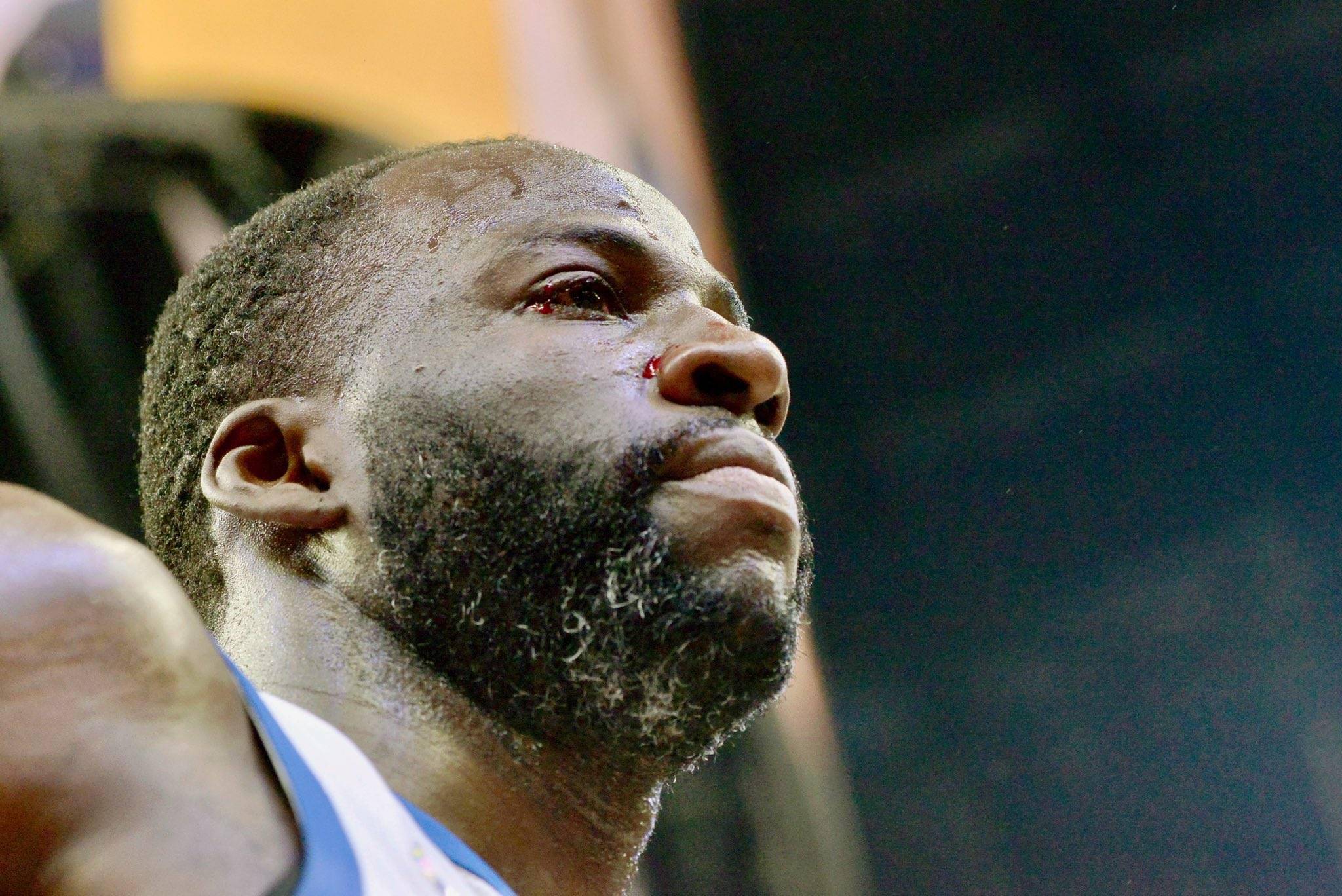 德雷蒙德格林的右眼肿了还有血迹