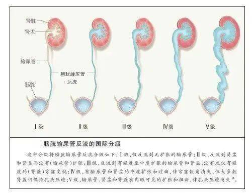 膀胱输尿管反流图片