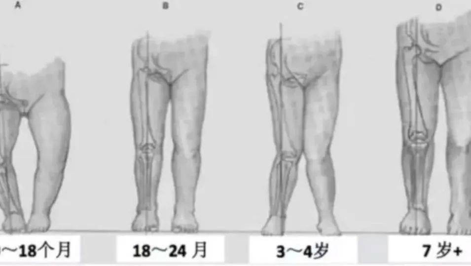 宝宝站太早，会导致腿变弯吗？