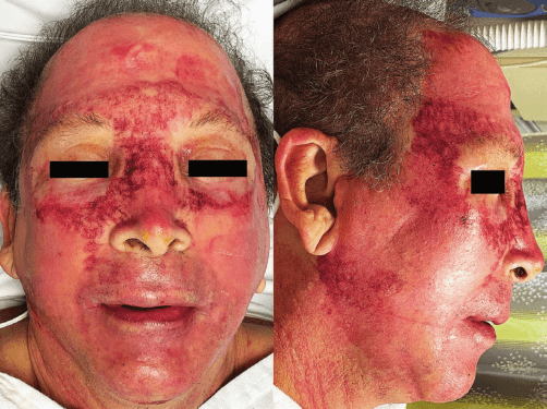 俯卧位发生『面部压疮』,麻醉医生有责任吗?_手术室_皮肤_损伤