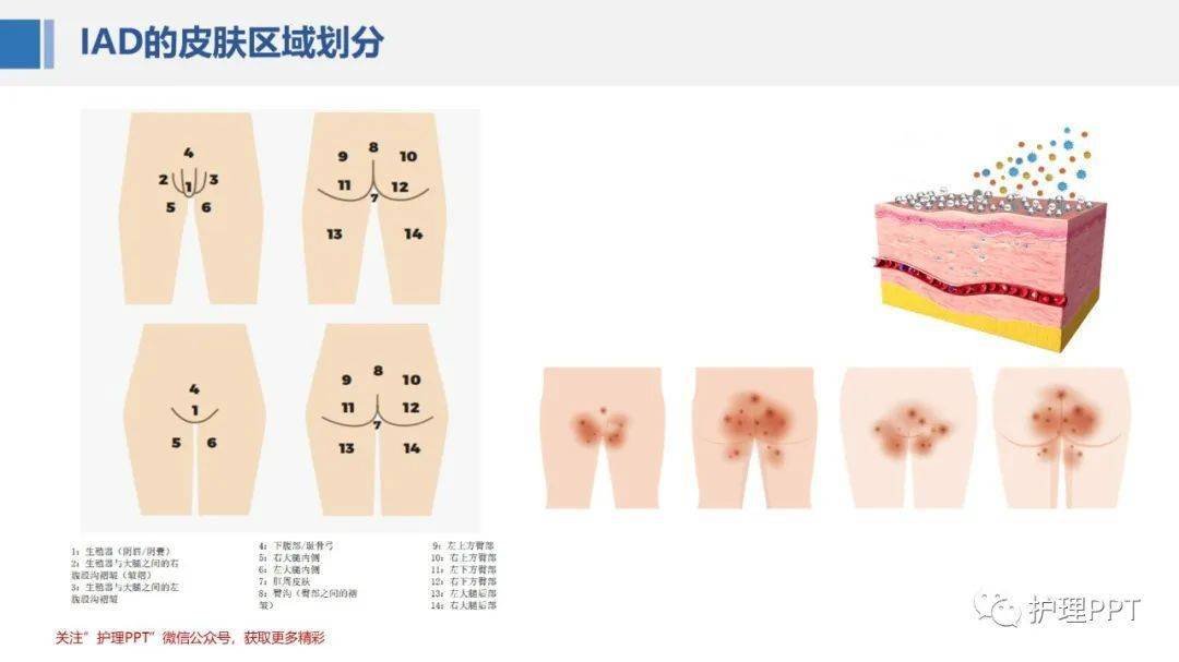 ppt失禁性皮炎的护理