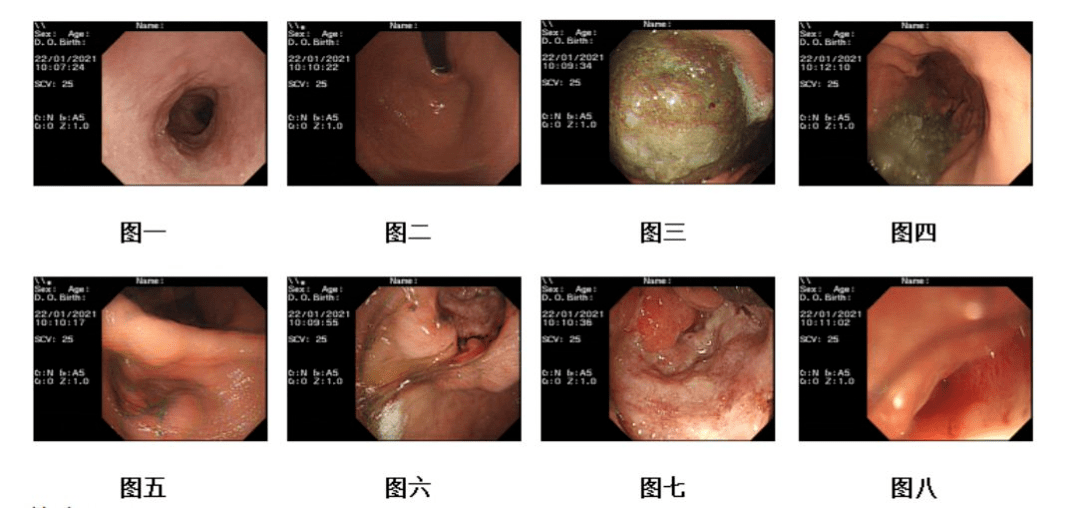 腹部ct2021年1月21日腹部ct:胃竇癌徵象,伴胃周,腹膜後增大淋巴結,請