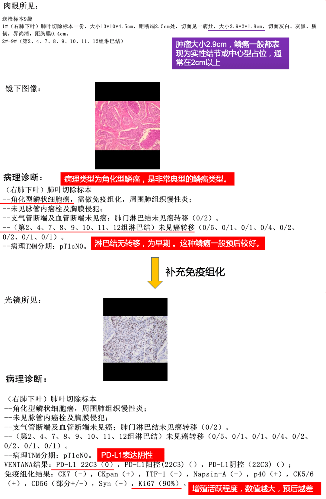 如何看懂肺癌【病理报告】?