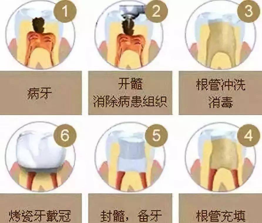 根管治疗的收费标准其实是这样滴!难度=费用_牙齿_神经_进行