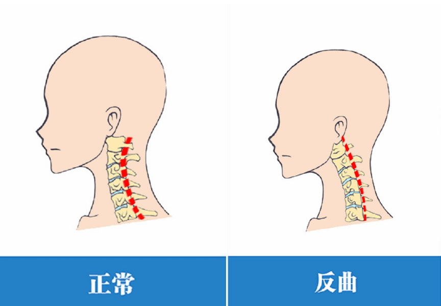 颈椎正常的生理曲线图图片