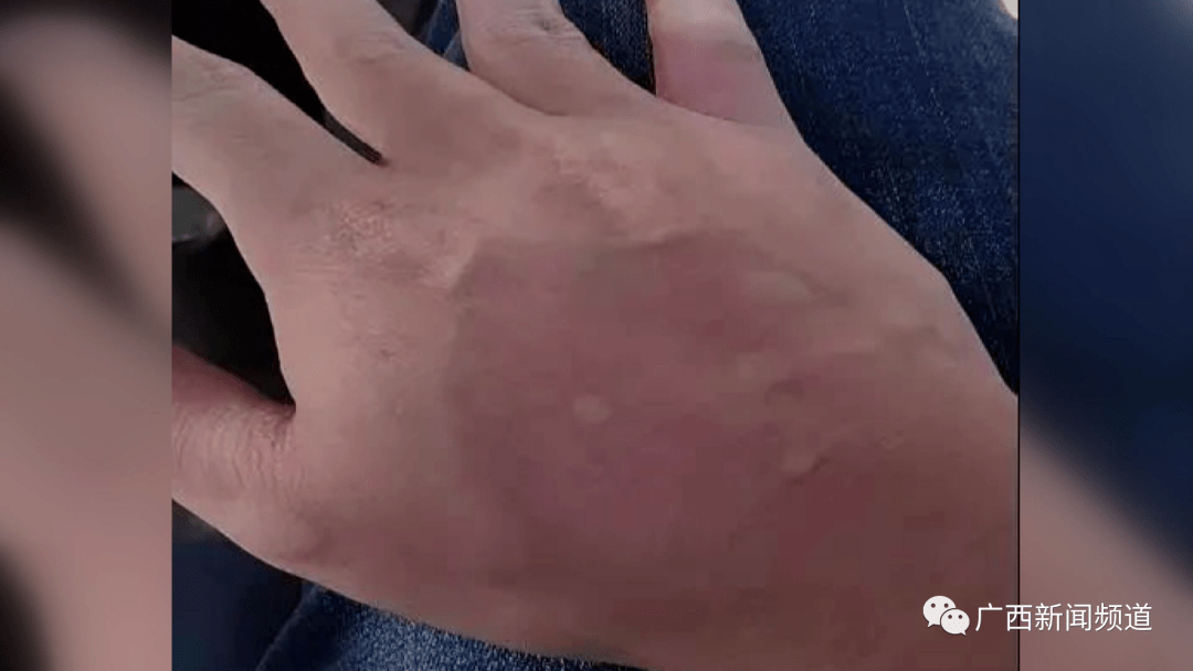 注意5月这种蚂蚁在蒙山频繁活动如被咬伤严重或丧命67