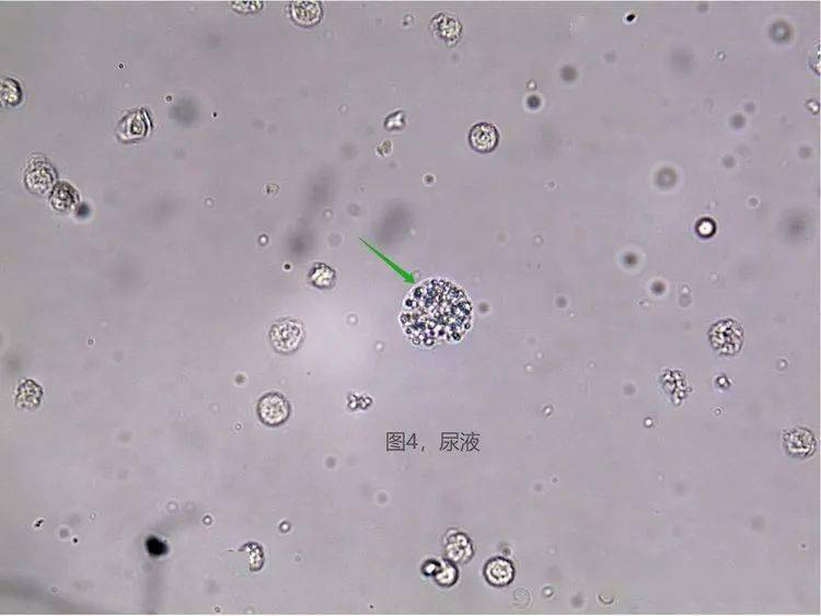 新生隐球菌革兰染色图片