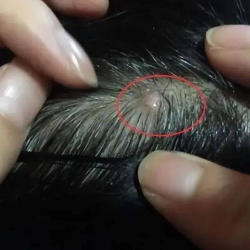 为啥头皮总爱长疙瘩和脓包，原因有这三个，看完要注意了！_洗头_头发_问题