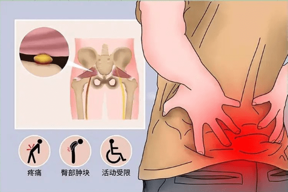 梨狀肌是一種扁平的帶狀肌肉,位