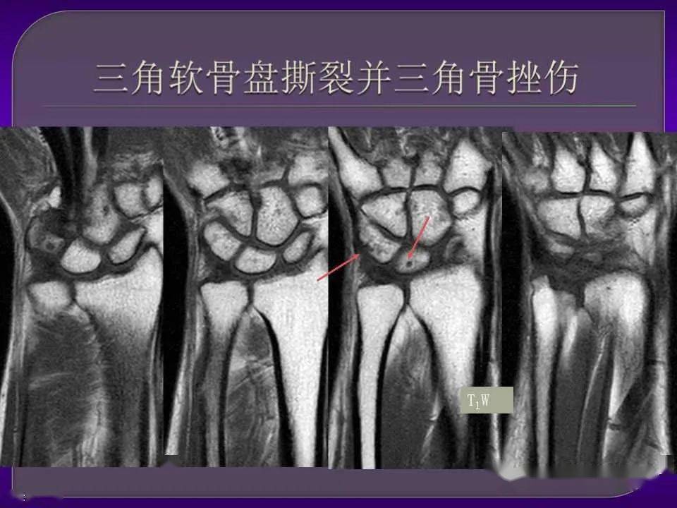 详细篇腕关节解剖及常见病变mri表现